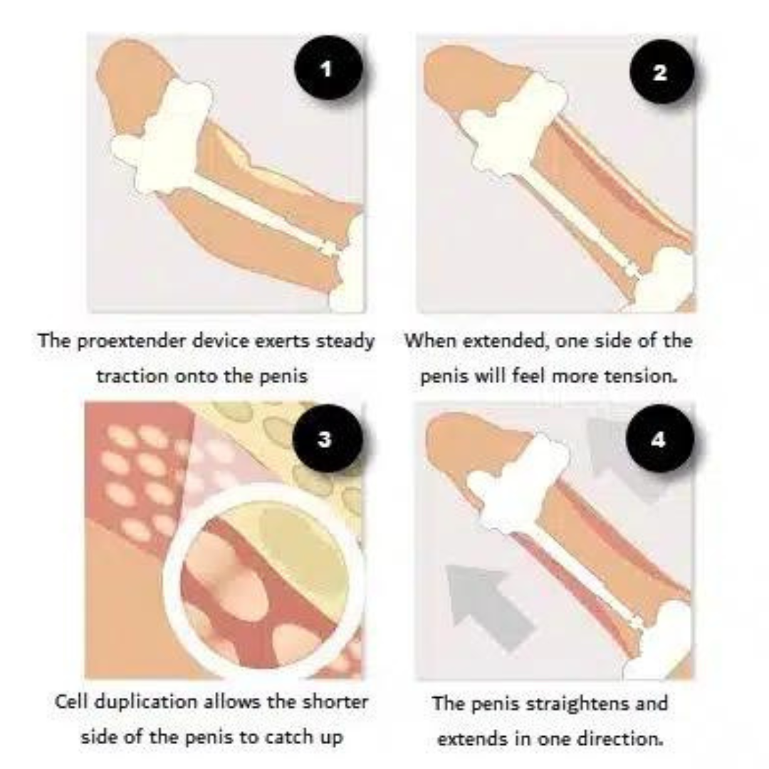 Pro Extender Penis Enlargement System - Image 5